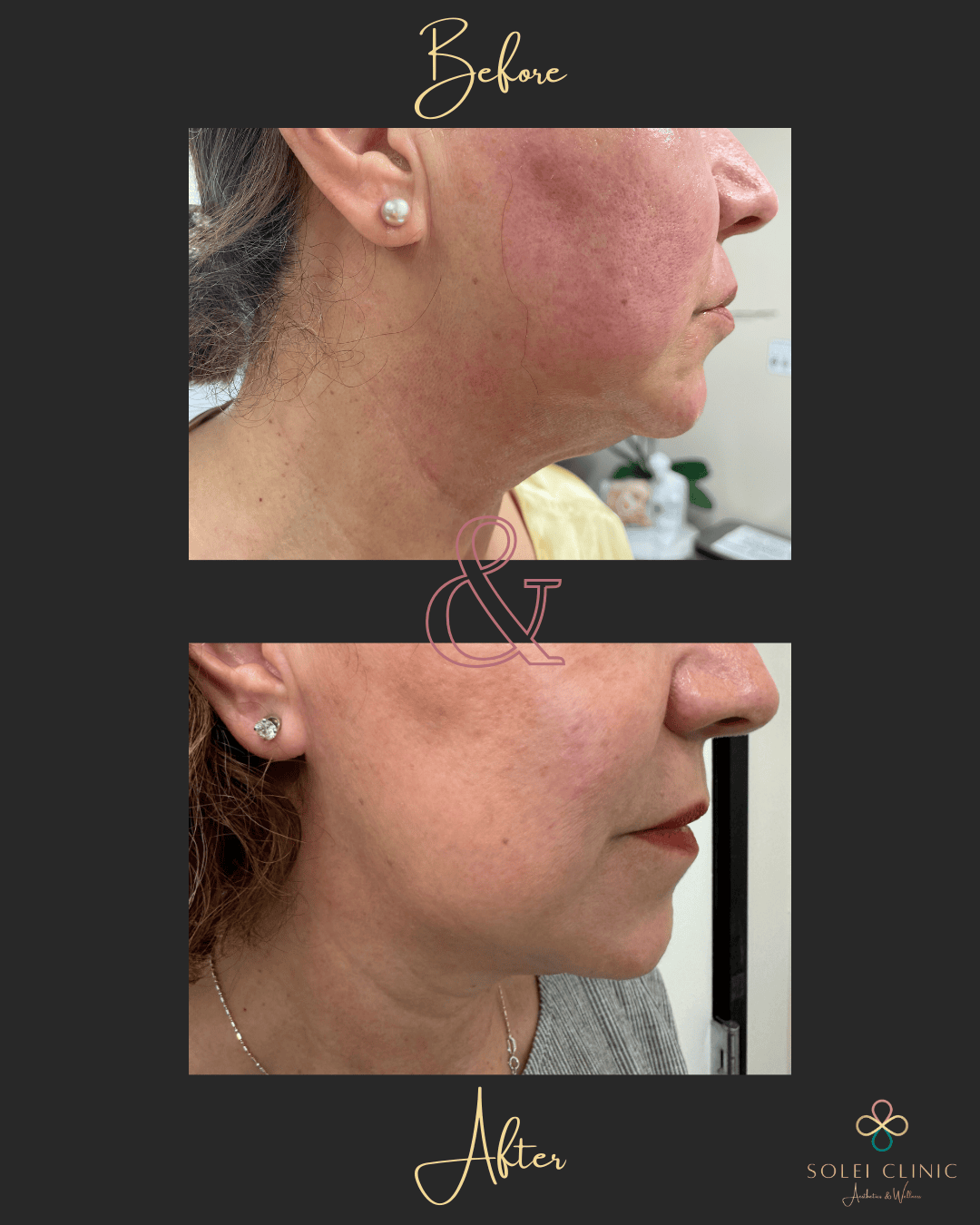 HIFU Shurink Chin & Neck Lift and Nasolabial Fold (1 session)