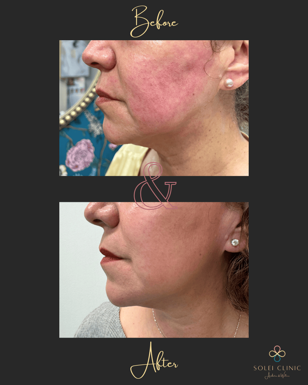 HIFU Shurink Chin & Neck Lift and Nasolabial Fold