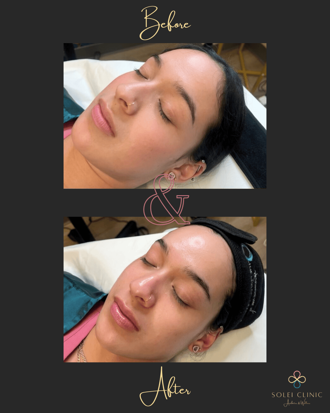 Oxygen Glass Skin Facial