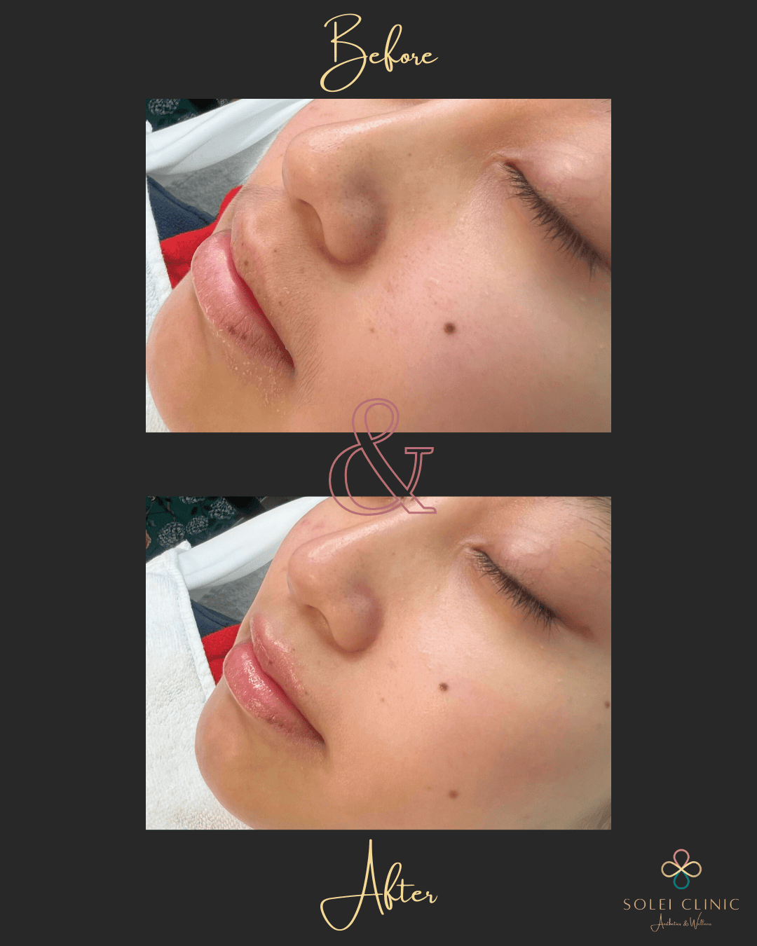 Oxygen Glass Skin Facial