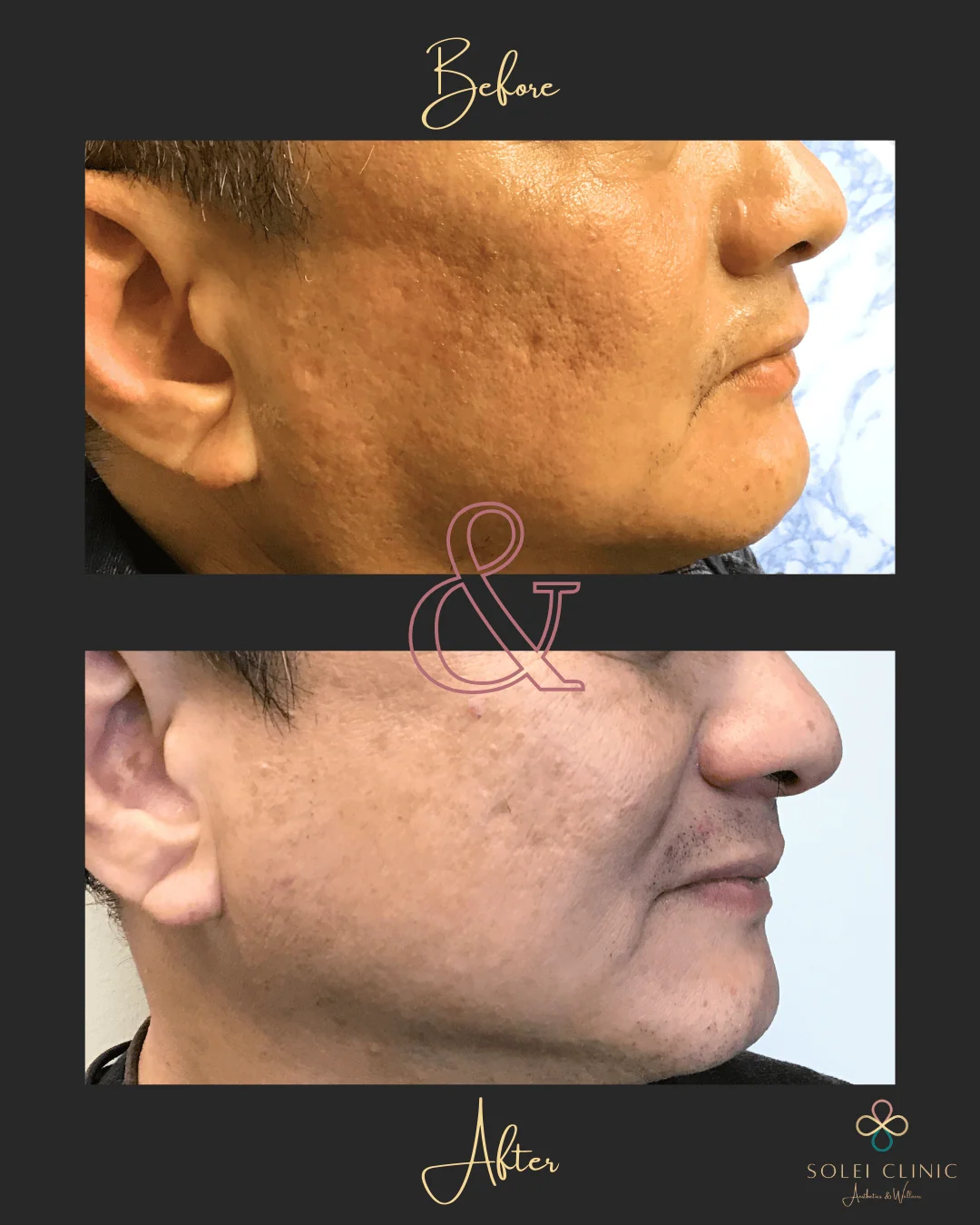 One Session Of Microneedling