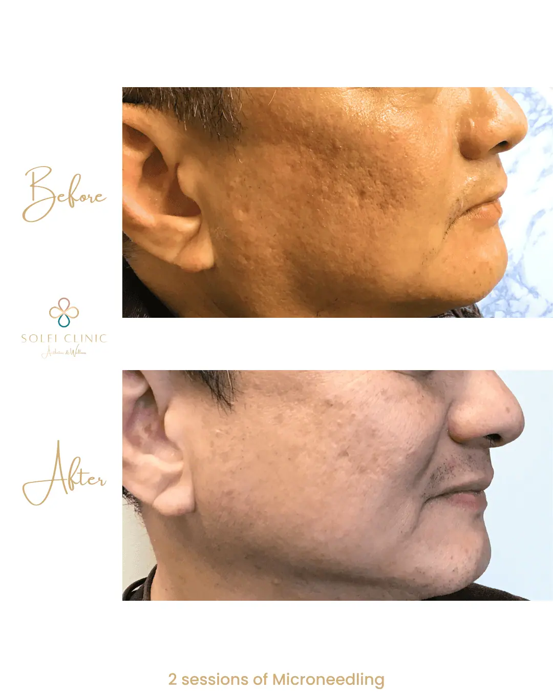 2 sessions of Microneedling