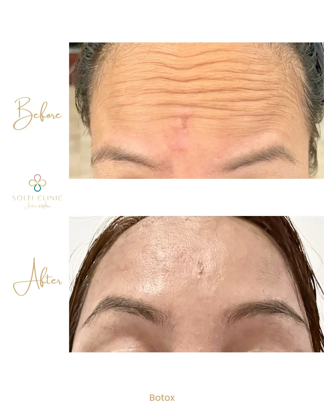 Botox - a woman with a few pictures of her face