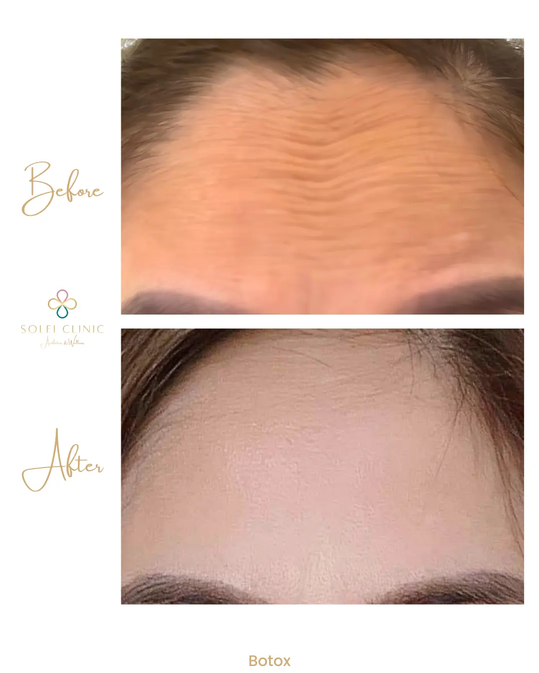 Botox - a woman with a few pictures of her face