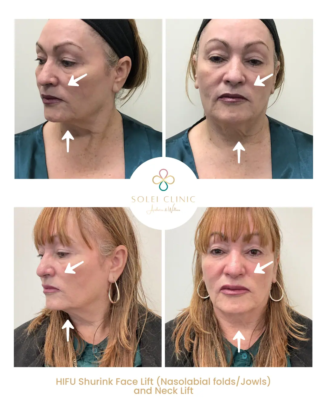 HIFU Face & Neck Lift