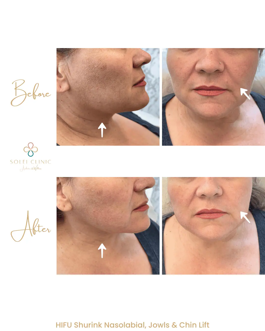 HIFU Shurink Nasolabial, Jowls & Chin Lift