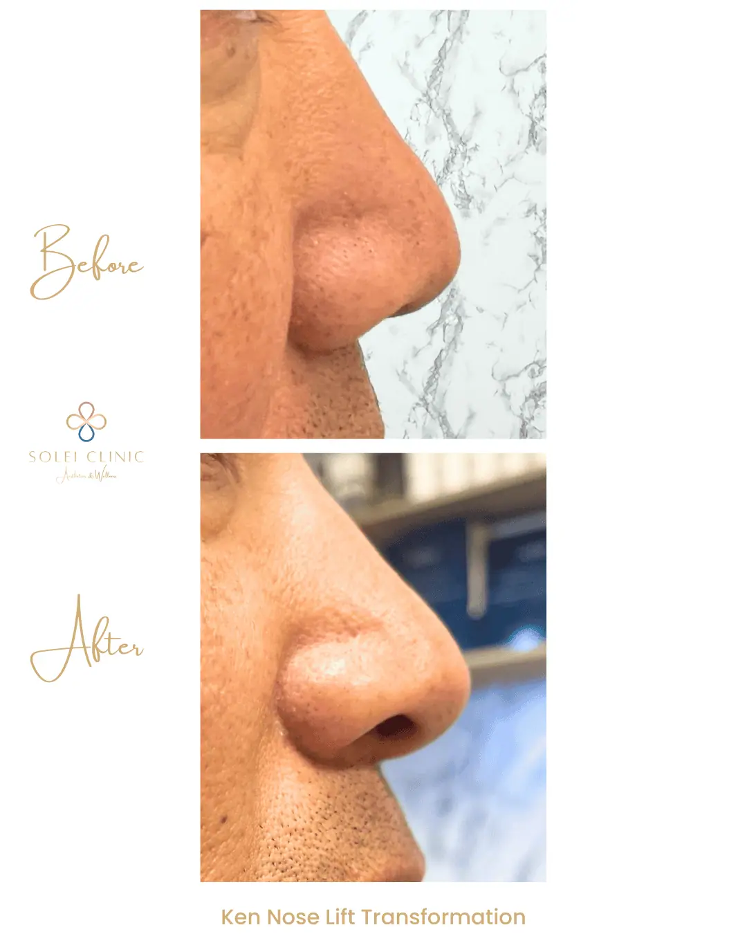 Ken Nose Lift Transformation