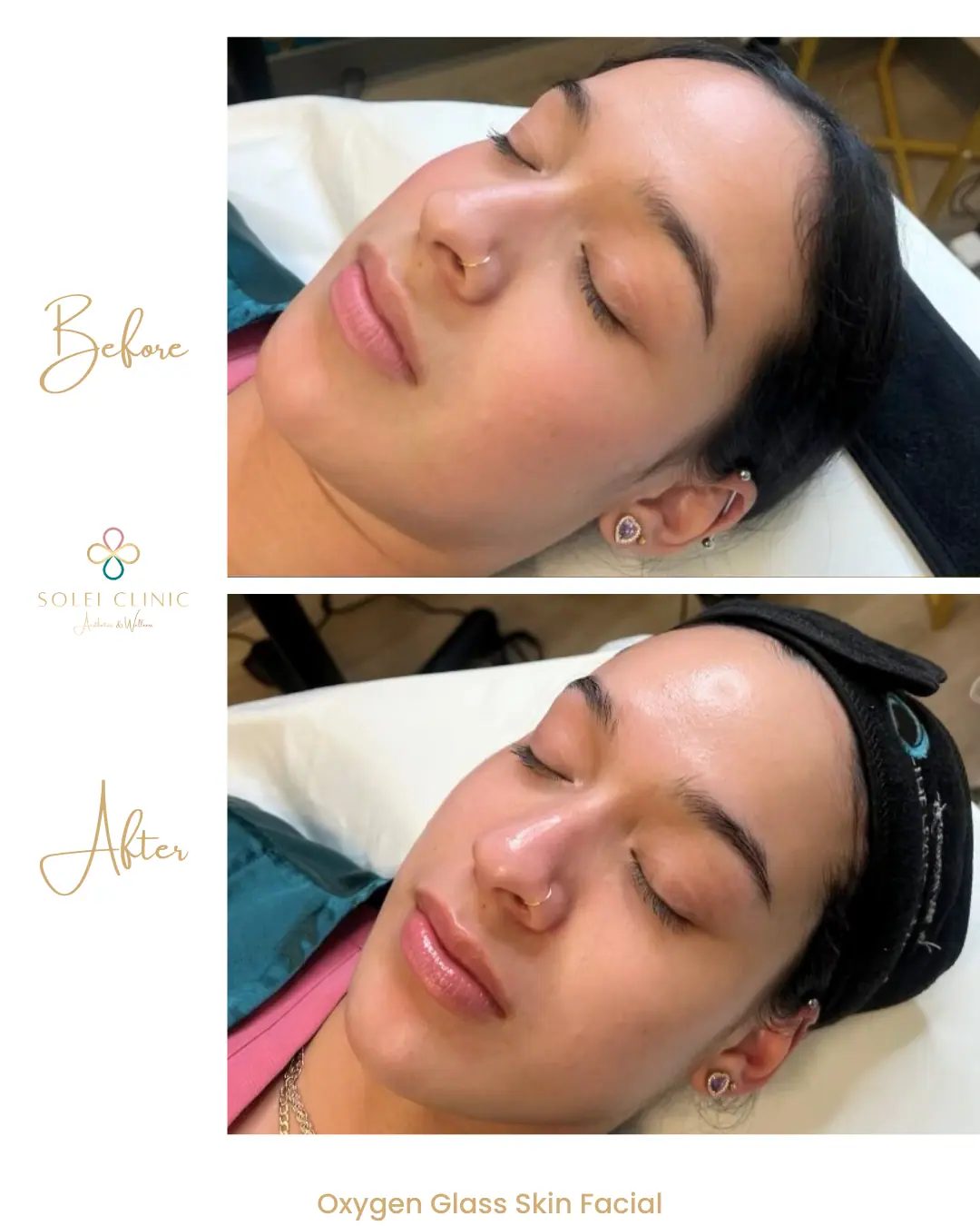 Oxygen Glass Skin Facial