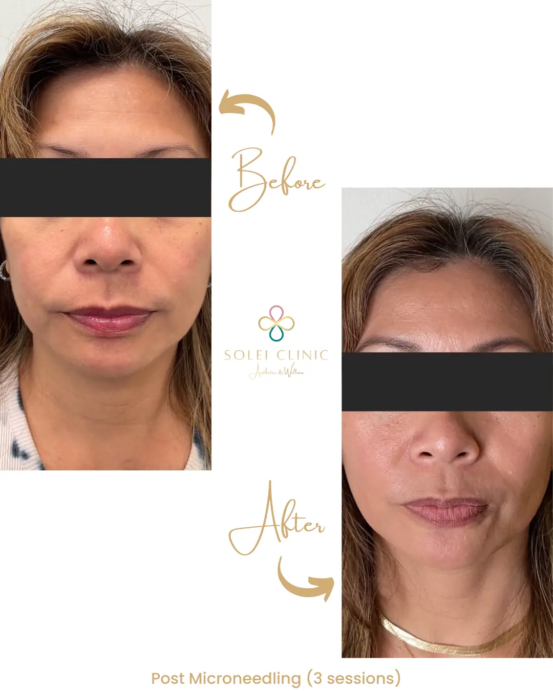 Post Microneedling