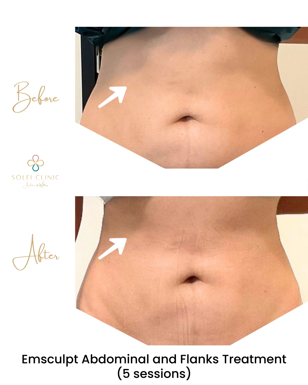 Emsculpt Abdominal and Flanks Treatment (5 sessions)