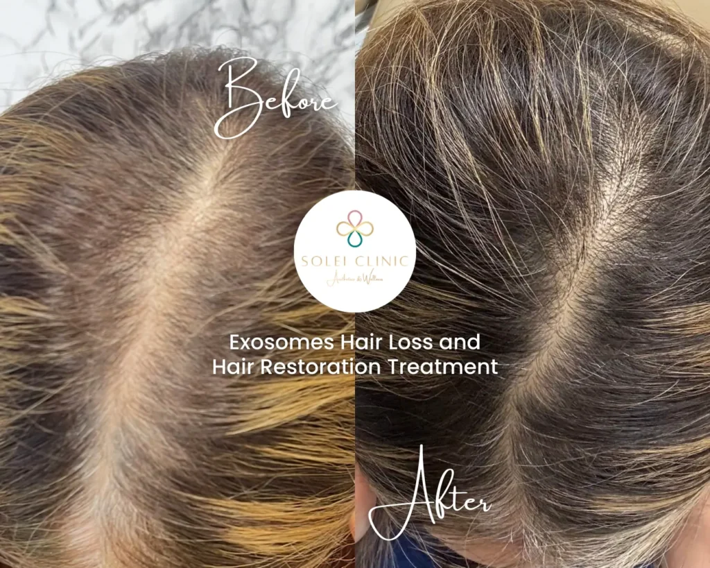 Exosomes Hair Restoration Treatment 1