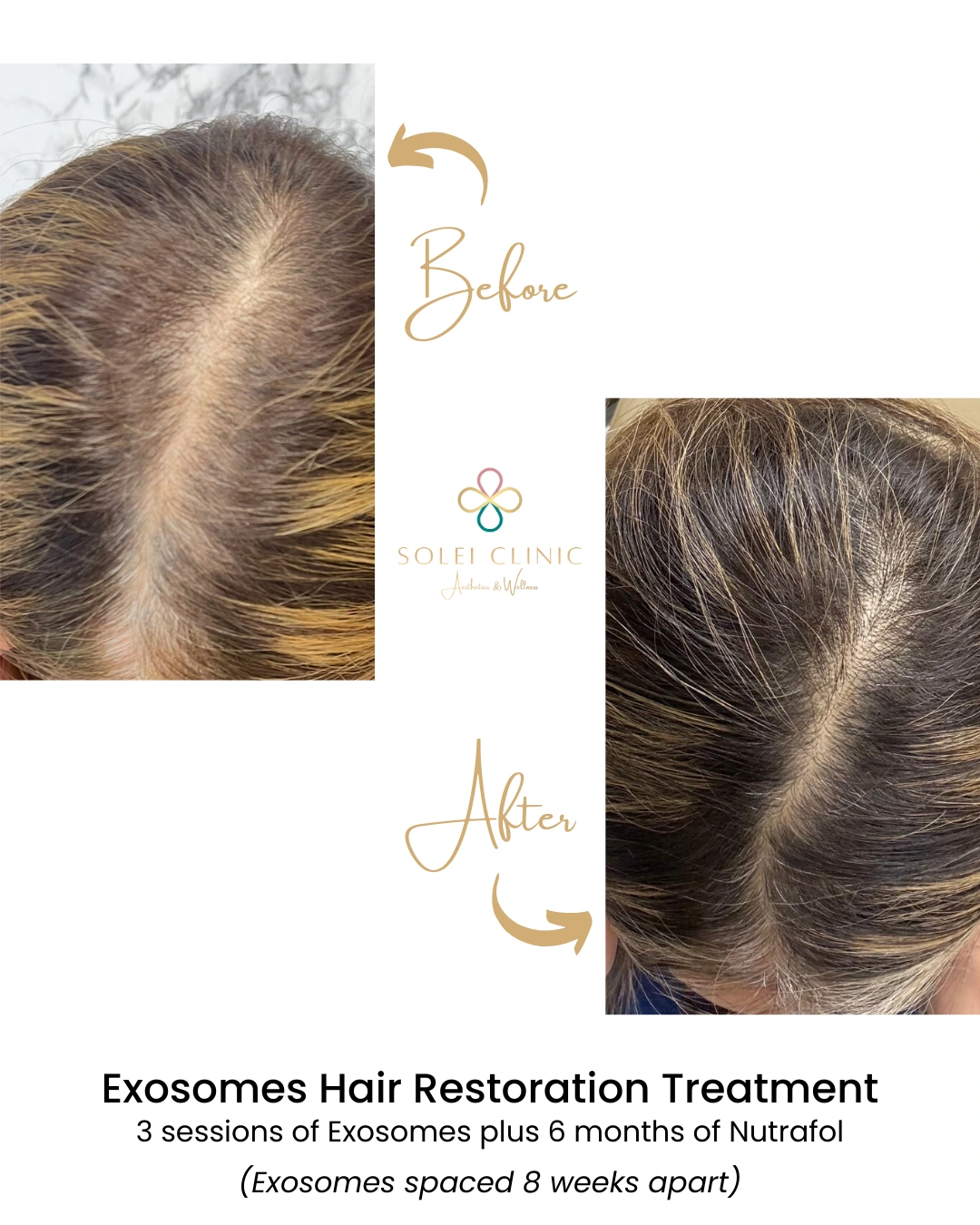 Exosomes Hair Restoration