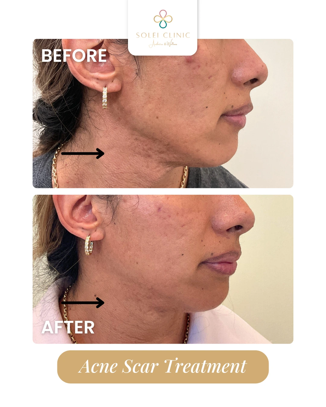 Acne Scar Treatment