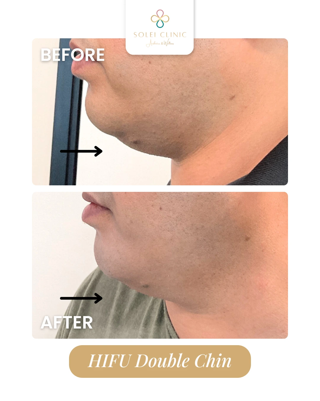 HIFU Double Chin
