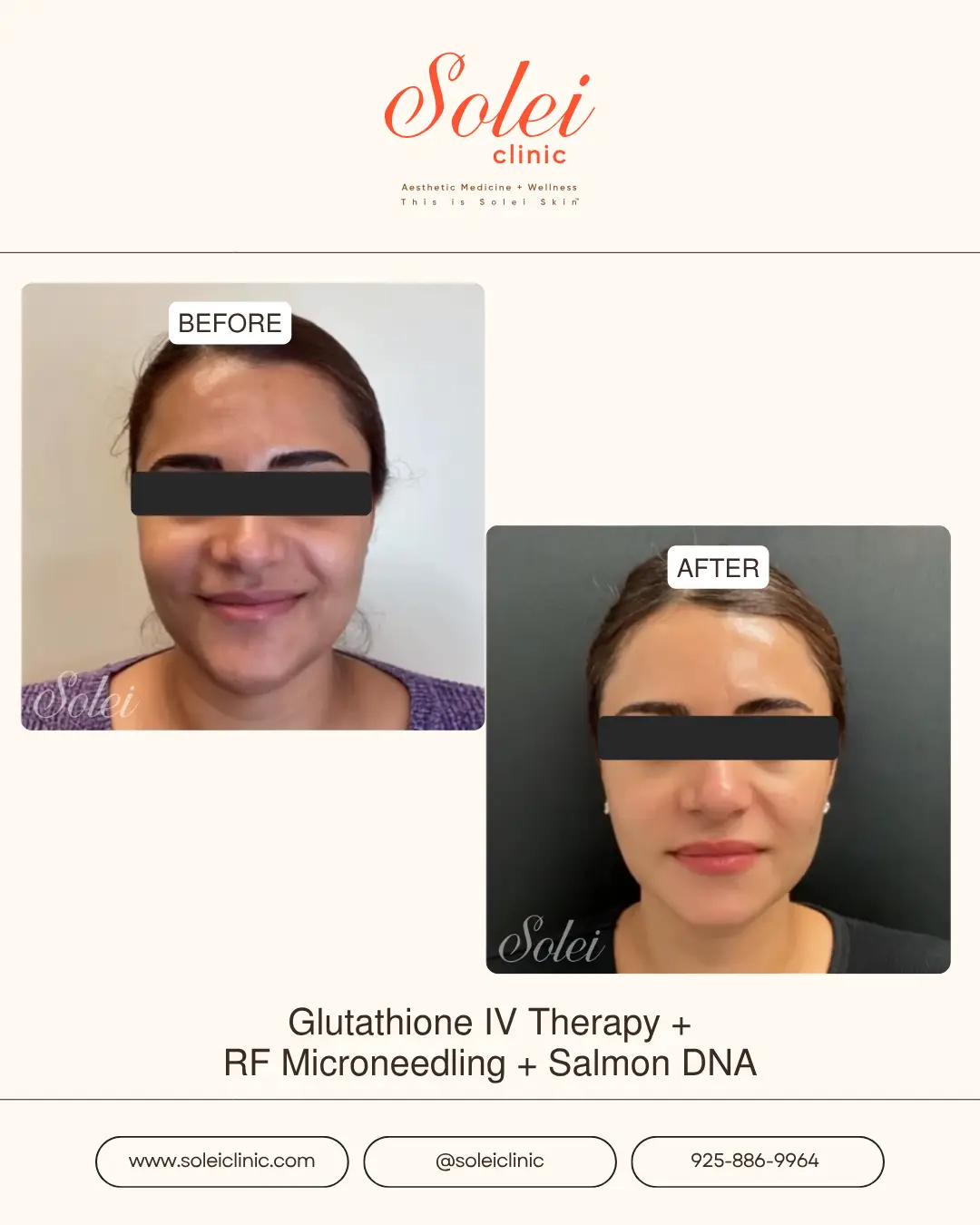 glutathione microneedling before and after & Transformations Images At Solei Clinic Muscles & Joints Vitamins